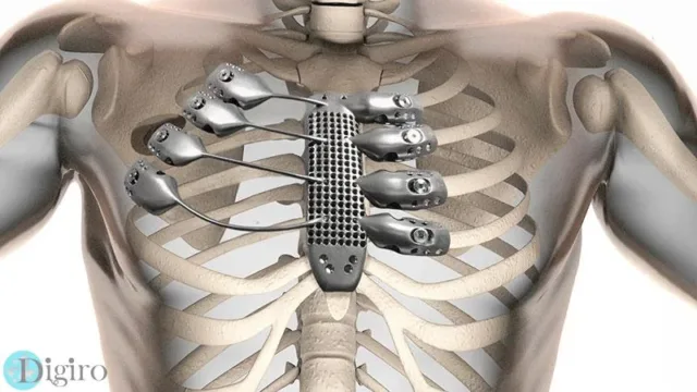 3d-printed-sternum-illustration