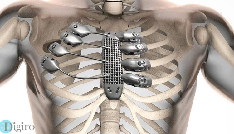3d-printed-sternum-illustration