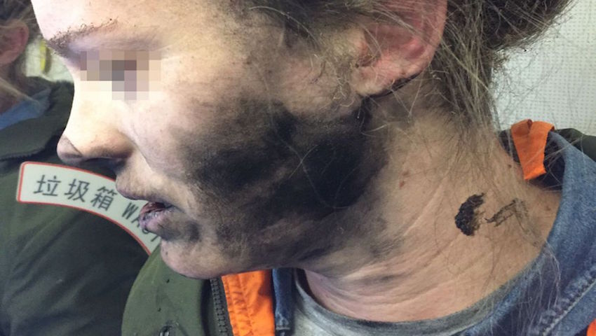 انفجار هدفون در هواپیما باعث سوختگی صورت زن مسافر!