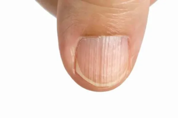 ظاهر ناخن‌ها چه چیزی درباره سلامت شما می‌گوید؟