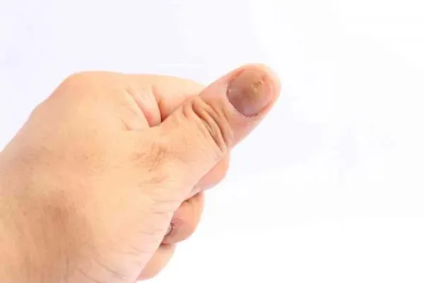 ظاهر ناخن‌ها چه چیزی درباره سلامت شما می‌گوید؟