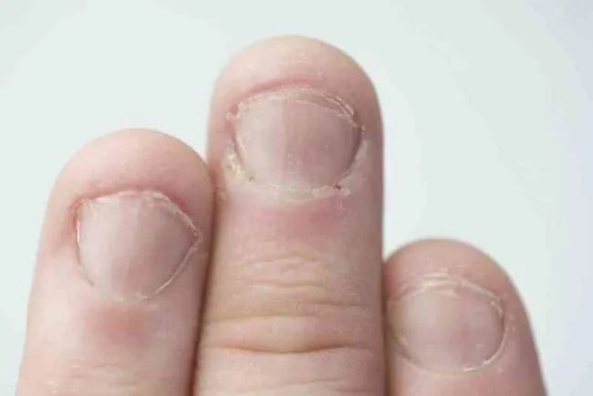 ظاهر ناخنها چه چیزی درباره سلامت شما میگوید؟