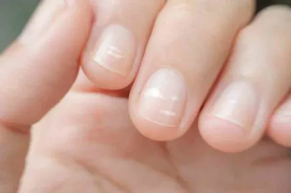 ظاهر ناخن‌ها چه چیزی درباره سلامت شما می‌گوید؟