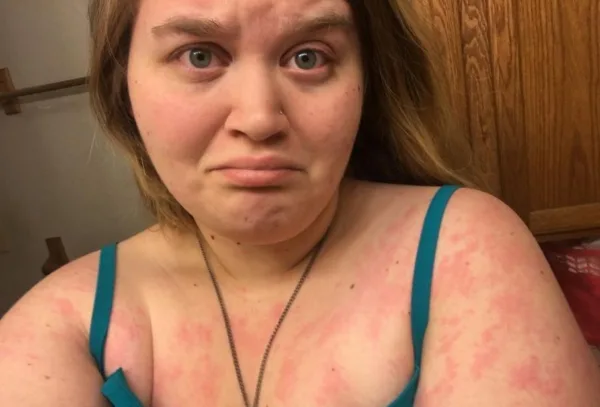 Cold urticaria