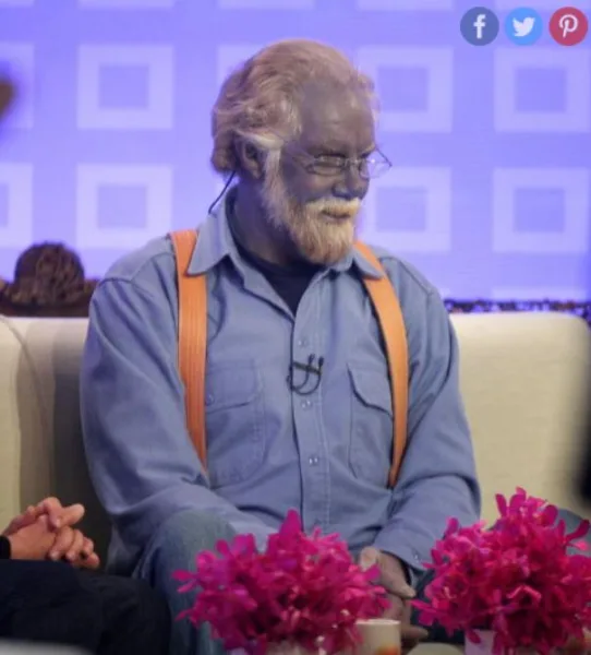 Argyria