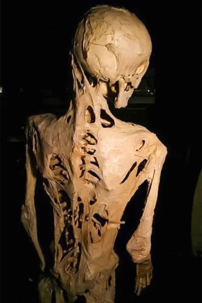 Fibrodysplasia
