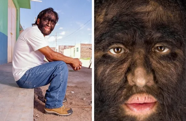 Hypertrichosis