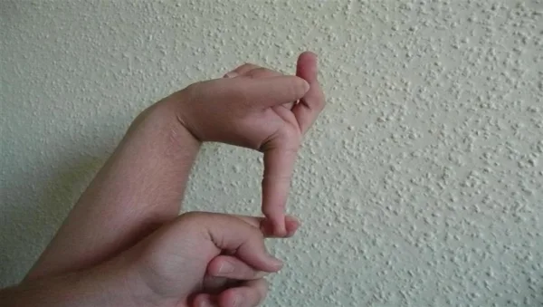 Ehlers—Danlos syndrome