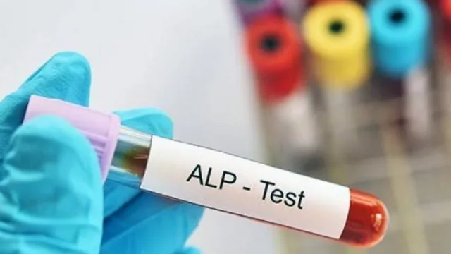 تشخیص بیماری های کبد با آزمایش ALP
