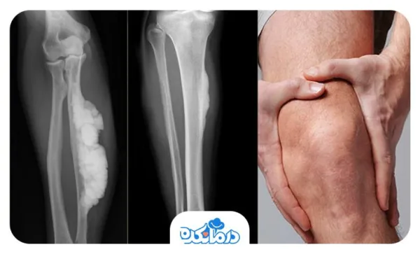 چگونه انواع بیماری آرتروز Arthritis سلامتی شما را تهدید میکنند؟