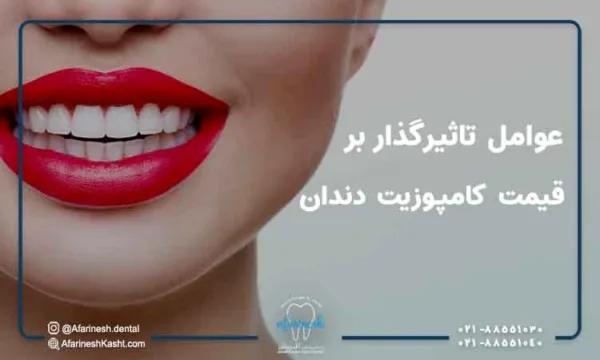 کامپوزیت دندان