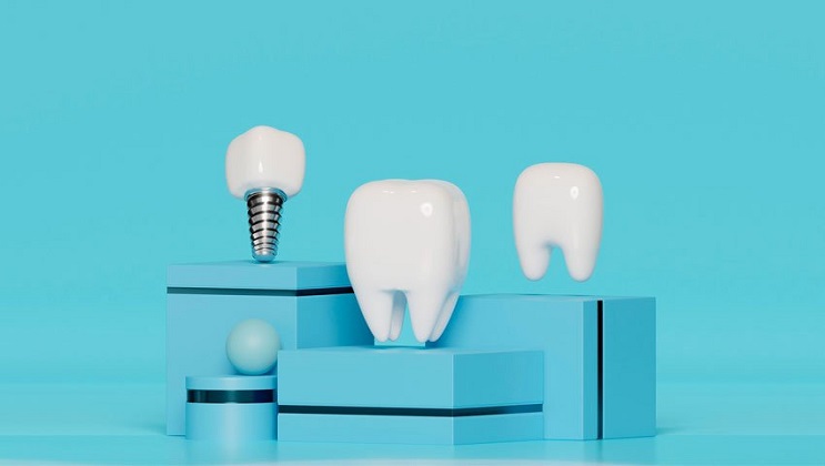 آشنایی با انواع ایمپلنت دندان