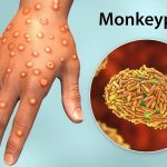 آبله میمونی؛ یک بیماری ویروسی نوظهور و پیامدهای جهانی آن