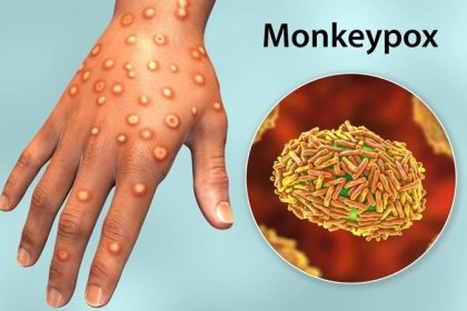 آبله میمونی؛ یک بیماری ویروسی نوظهور و پیامدهای جهانی آن