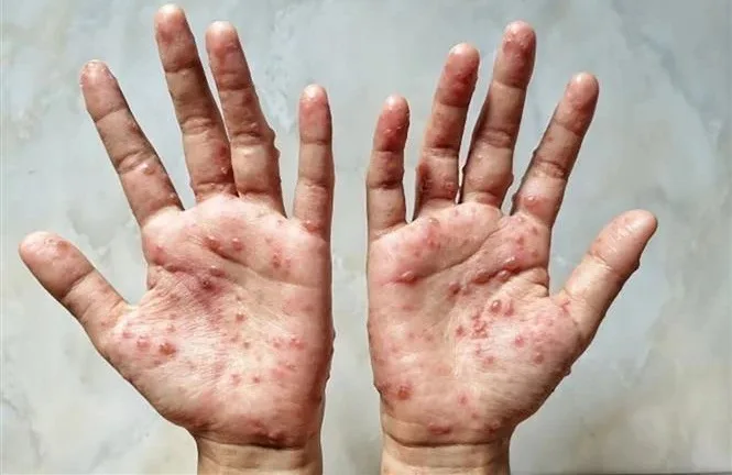 آبله میمونی؛ یک بیماری ویروسی نوظهور و پیامدهای جهانی آن