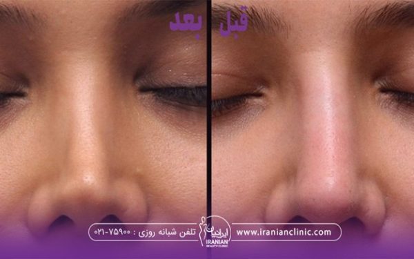 قبل و بعد فردی که عمل بینی انجام داده است