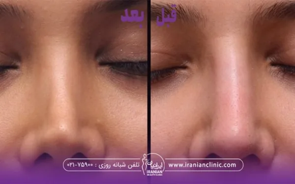 قبل و بعد فردی که عمل بینی انجام داده است