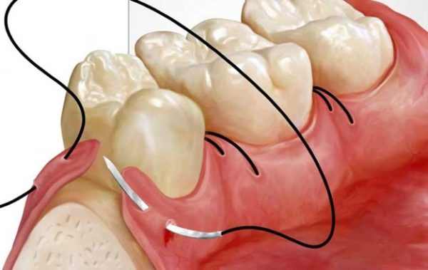 جراحی لثه برای روکش جراحی لثه برای روکش