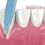 جراحی لثه برای روکش