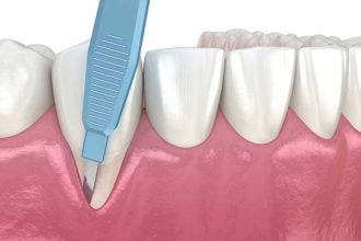 جراحی لثه برای روکش