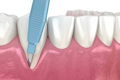 جراحی لثه برای روکش