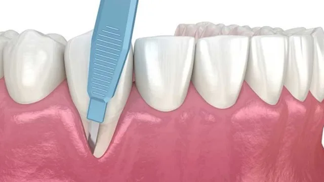 جراحی لثه برای روکش