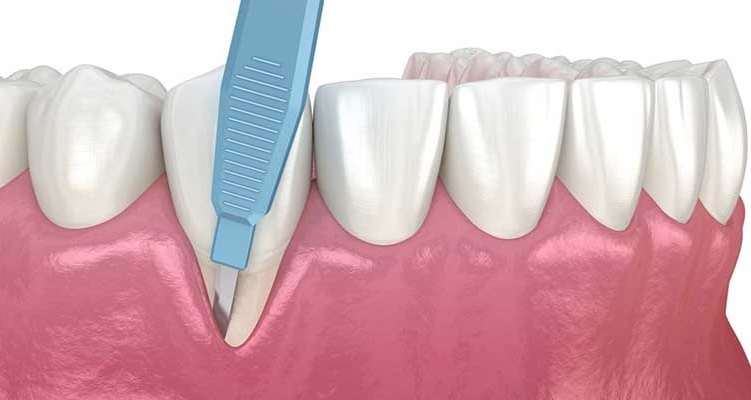 جراحی لثه برای روکش